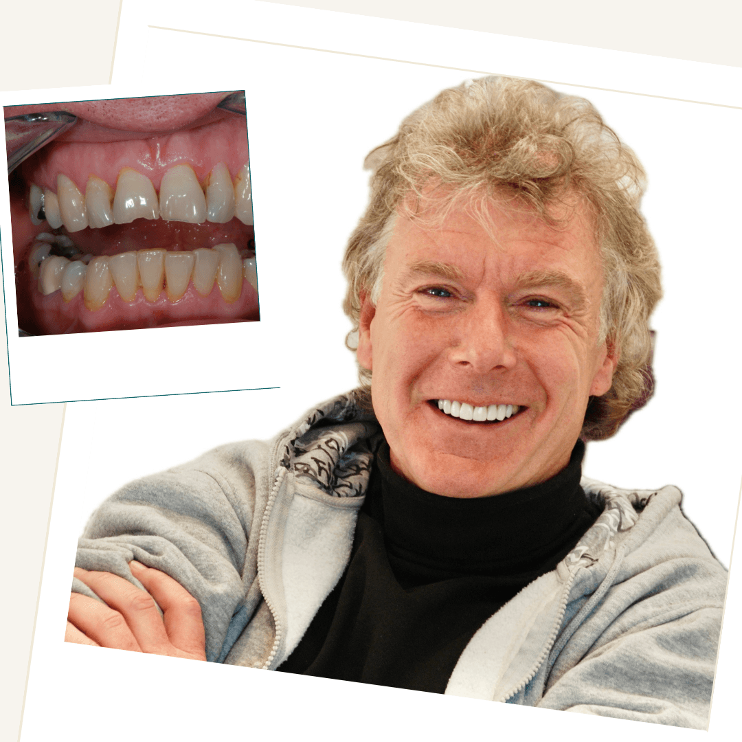 Patient following conservative aesthetic dental treatment