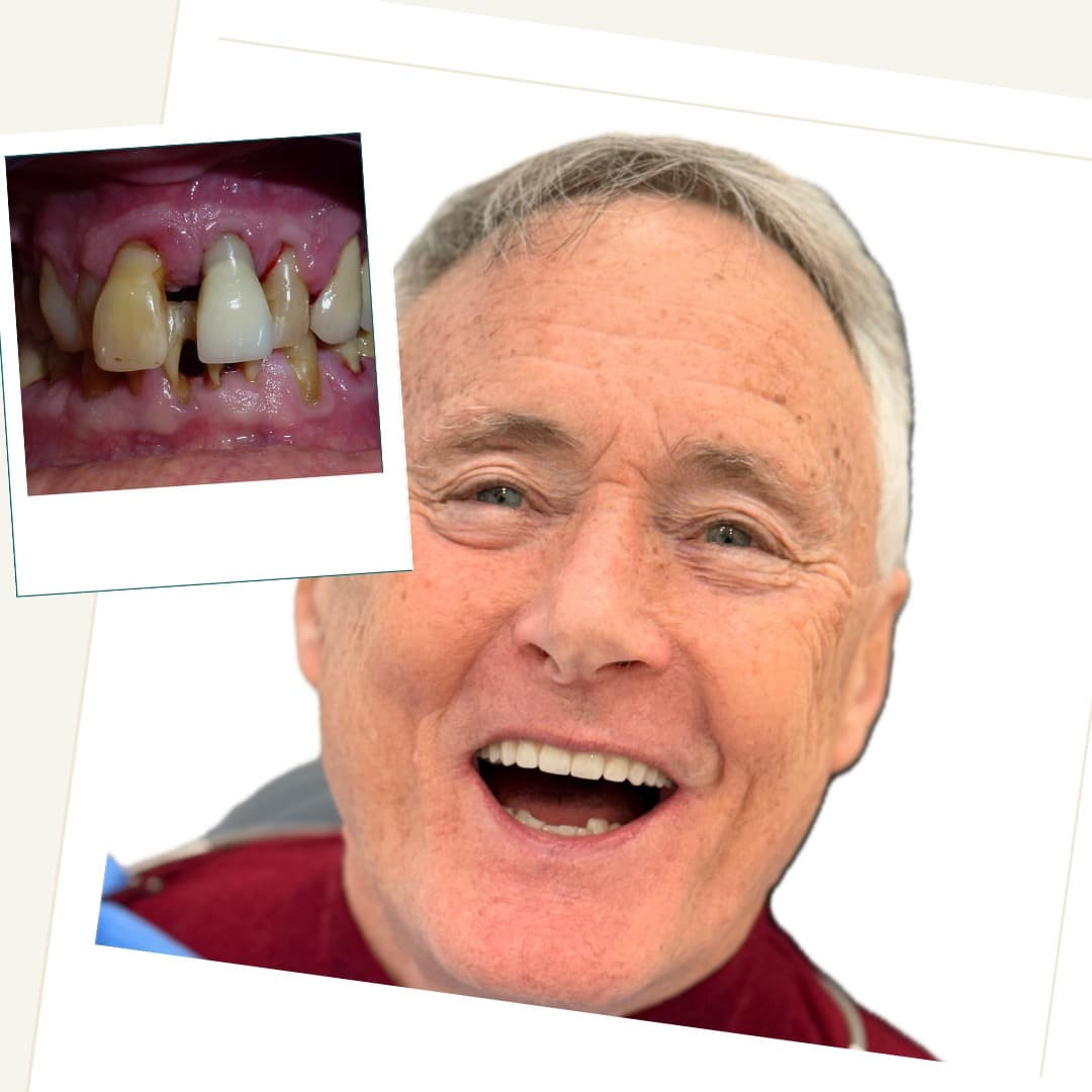 Patient following full-arch implant rehabilitation, with an inset clinical photograph