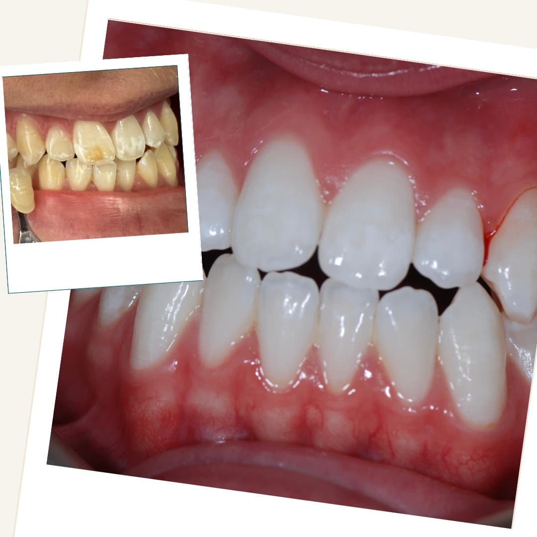Before and after clinical mapping of ICON resin infiltration on mottled front teeth