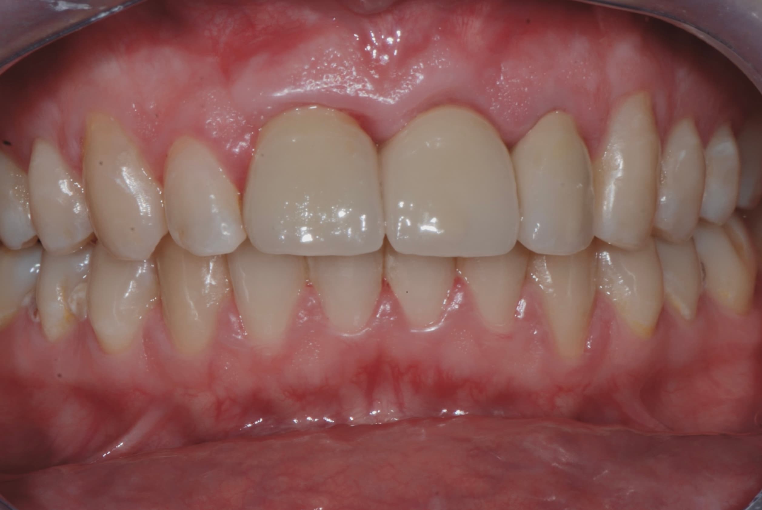 Anterior implant-supported bridge at a five-year clinical review