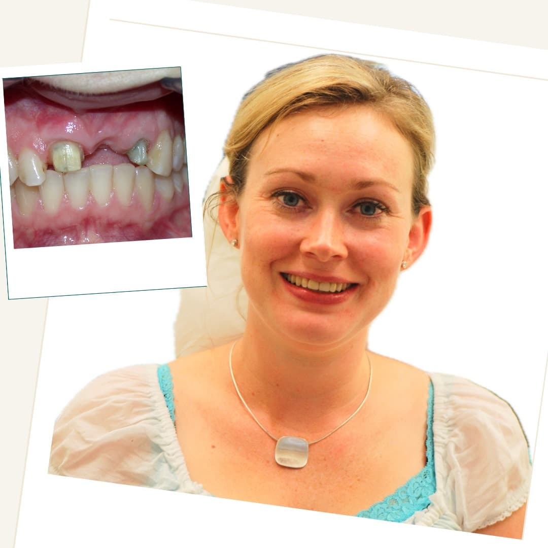 Patient following anterior implant-supported bridge treatment, with an inset clinical photograph