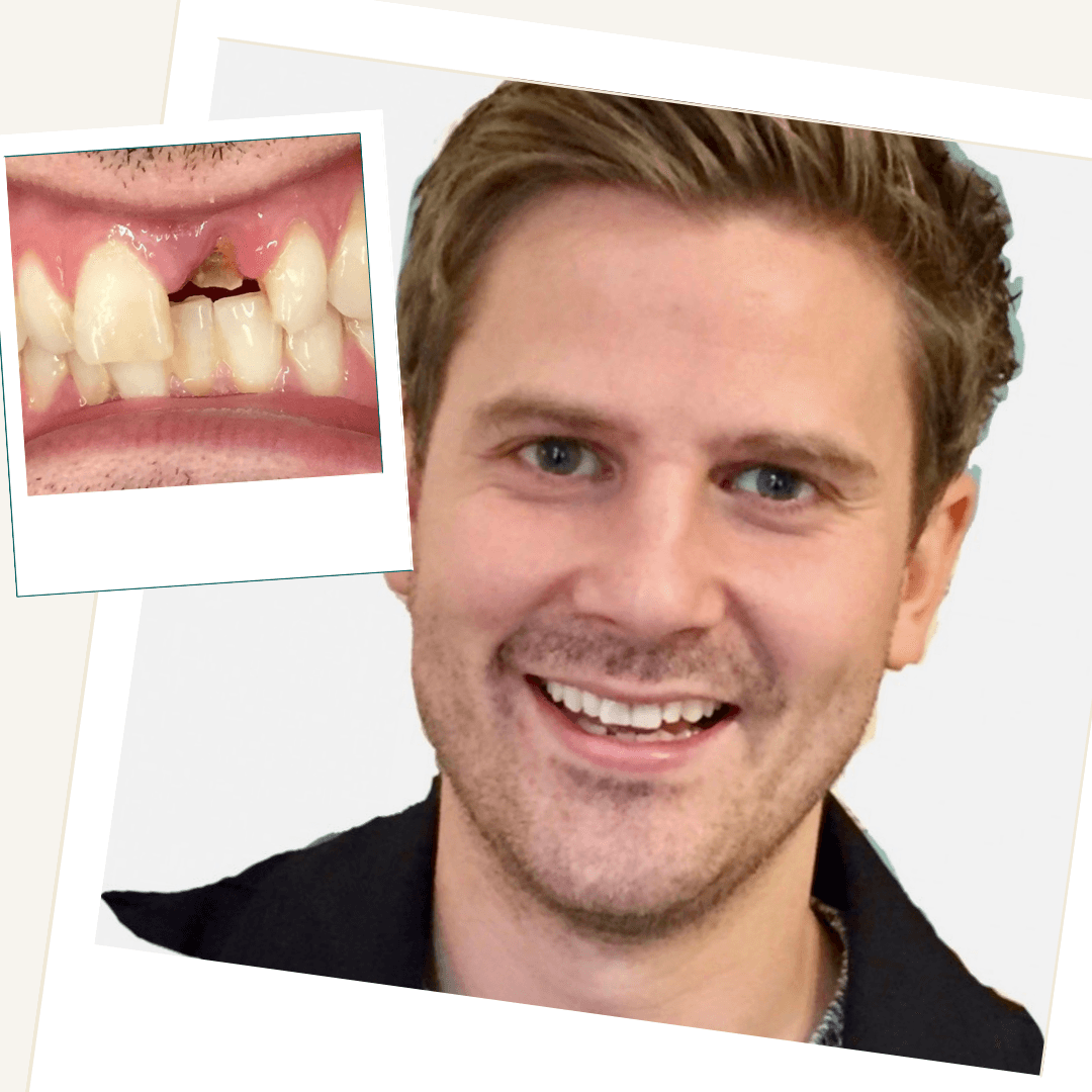 Single dental implant replacing a broken front tooth