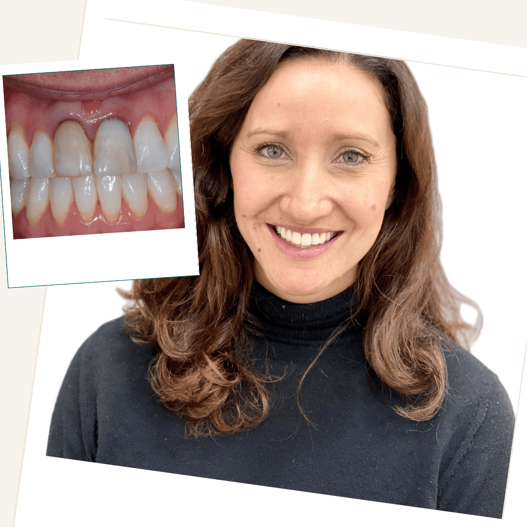 Internal Whitening with Crowns clinical case result