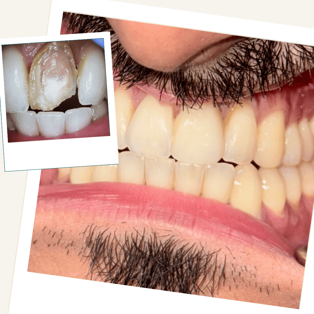 Root Canal, Whitening & Veneer clinical case result