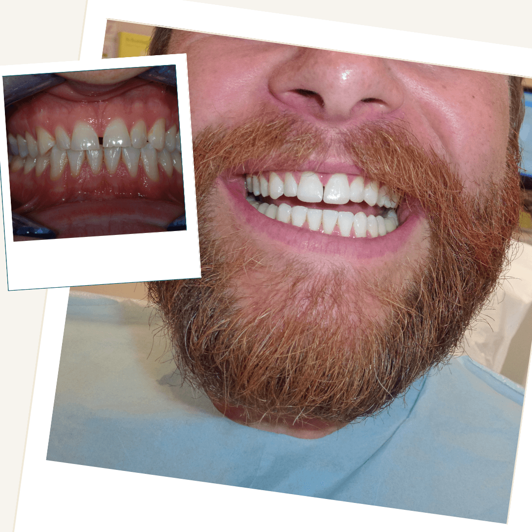 Patient following conservative composite bonding for tooth wear