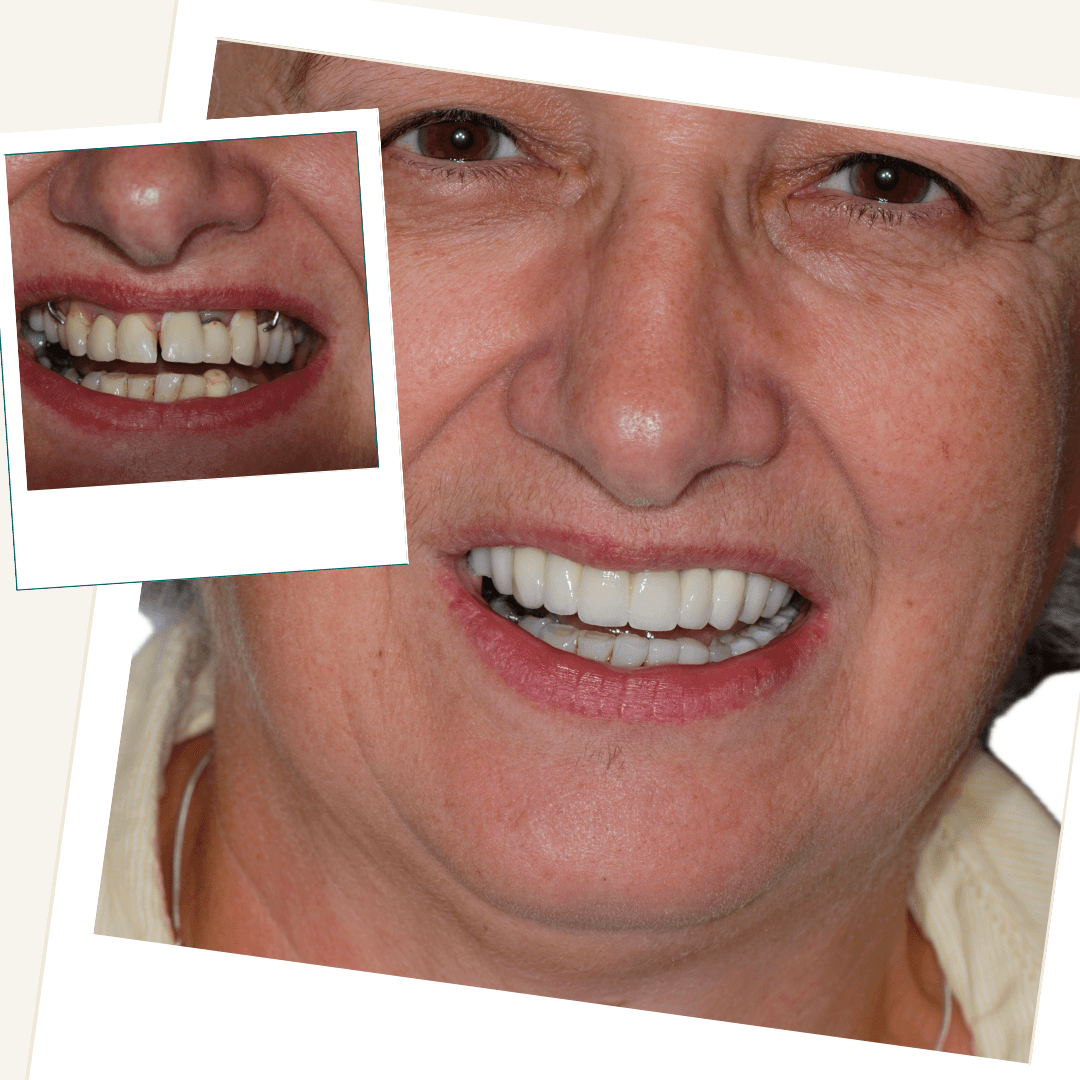 Patient before and after complex restorative care using implants, bridges and crowns