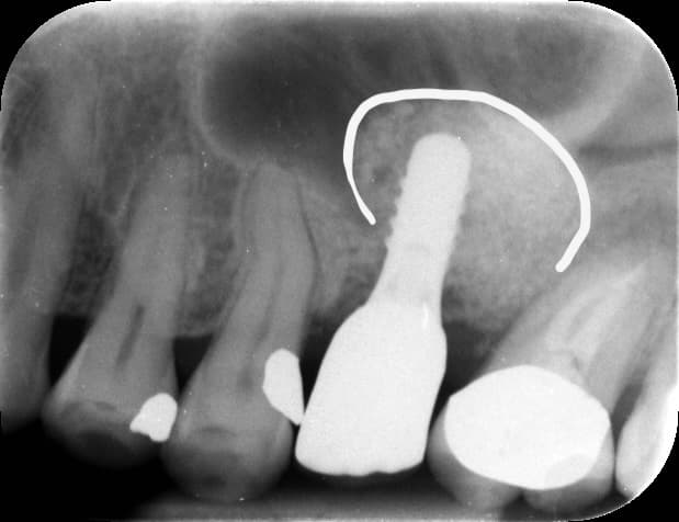 Follow-up dental radiograph of the restored upper posterior implant site