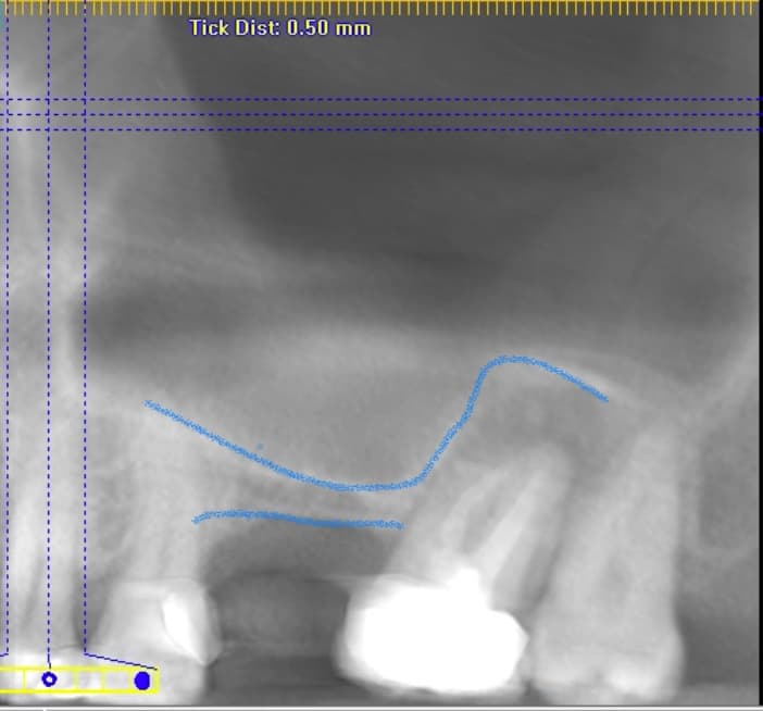 Pre-operative dental radiograph of an upper posterior implant site before sinus augmentation