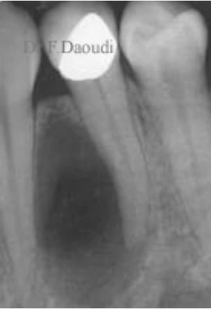 Pre-treatment radiograph of a lower-left first premolar with a large apical radiolucency