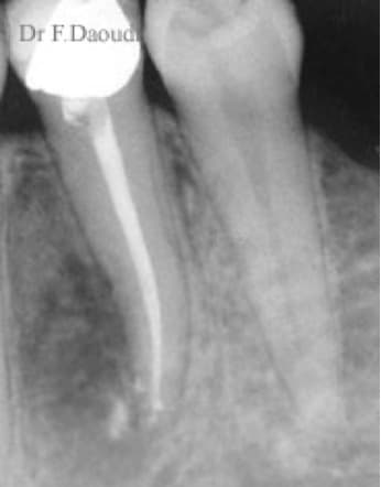 Follow-up radiograph after non-surgical root-canal treatment of a lower-left first premolar