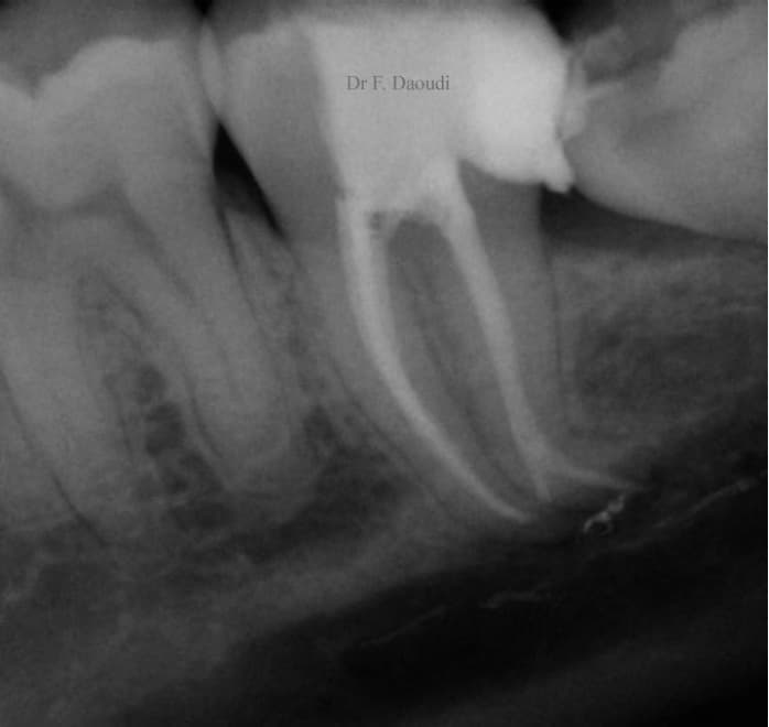 Post-treatment radiograph of a lower-left second molar showing obturated curved root-canal anatomy