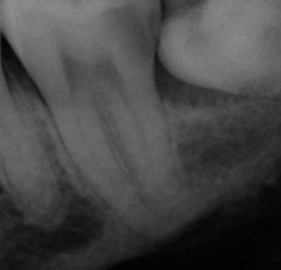 Pre-treatment radiograph of a lower-left second molar with pronounced distal root curvature