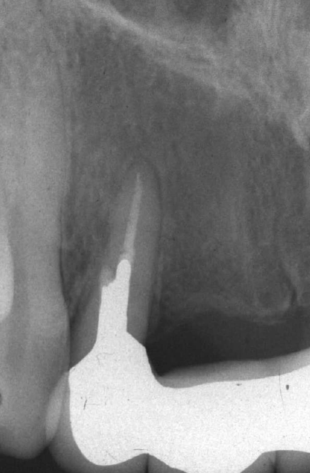 Twenty-year review radiograph after root-canal retreatment and perforation repair of an upper lateral incisor