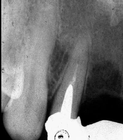Pre-treatment dental radiograph of an upper lateral incisor bridge abutment with an existing post and root filling