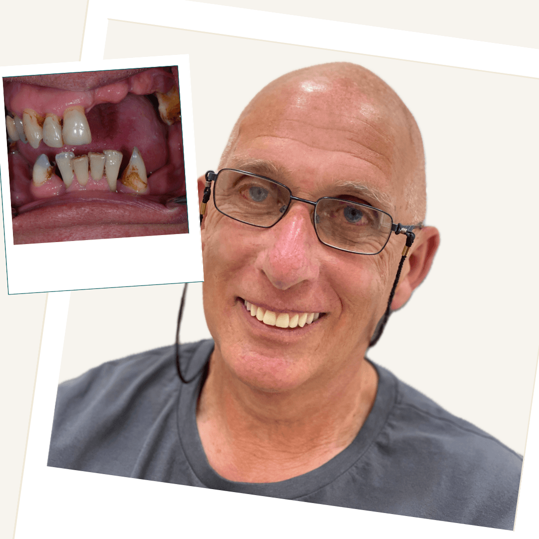 Implant-Retained Denture clinical case result